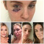 Celebrity Facialist Scandal: Woman Claims $90K Treatments Left Her Permanently Scarred Woman claims celebrity facialist left her permanently scarred after $90K treatments